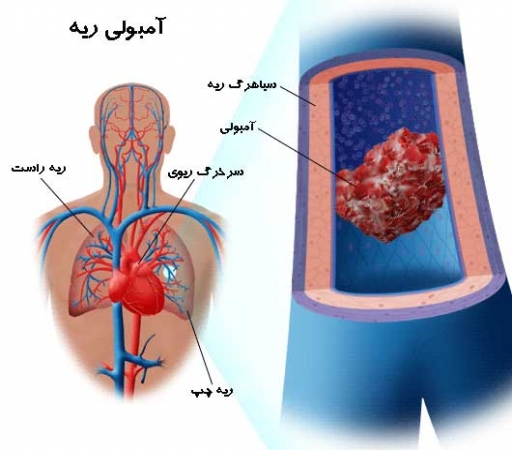 آمبولی ریوی