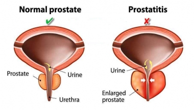 التهاب پروستات یا پروستاتیت
