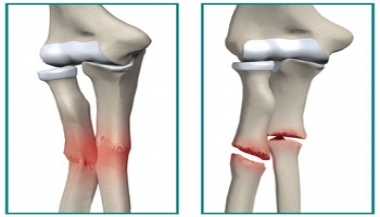 شکستگی فشاری در پا یا ساق پا