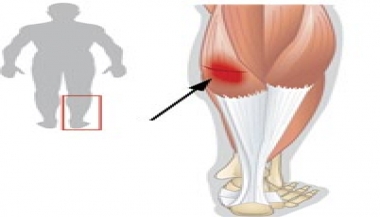 پارگی عضلات خلف ساق
