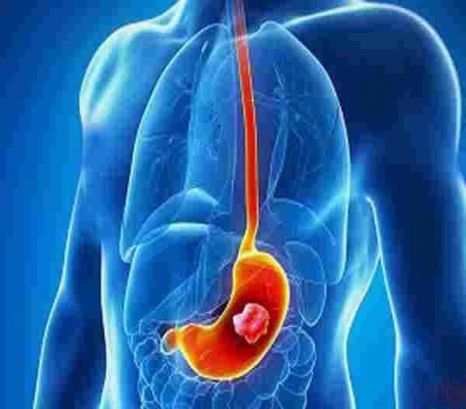 برگشت اسید معده به مری