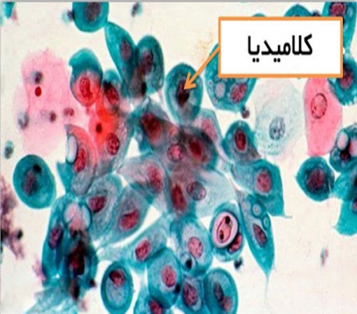 عفونت کلامیدیا