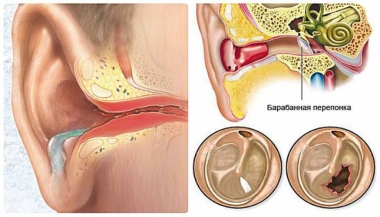عفونت های مجرای گوش خارجی