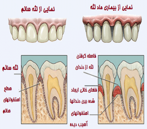 بیماری های لثه و دندان