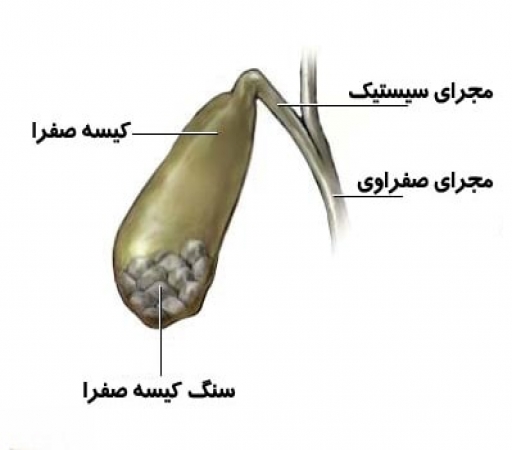 التهاب کیسه صفرا یا کوله سیستیت