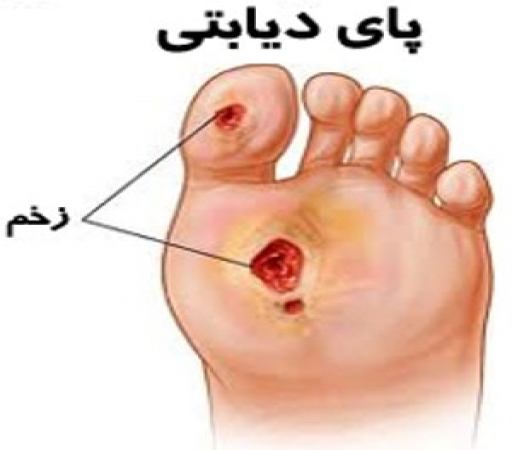 اجازه ندهید هر ۳۰ ثانیه پای یک دیابتی قطع شود