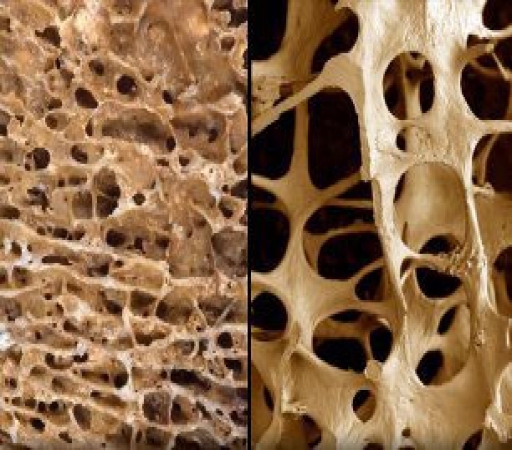 مردان هم دچار پوکی‌استخوان می‌شوند