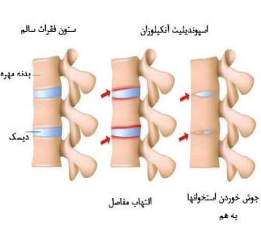 شیوع روماتیسم ستون فقرات در دوران جوانی