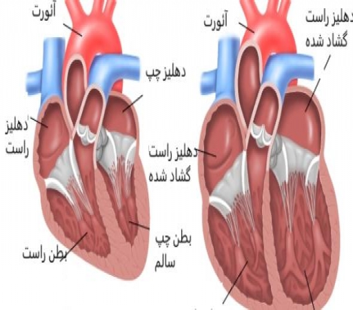 بیماری قلبی