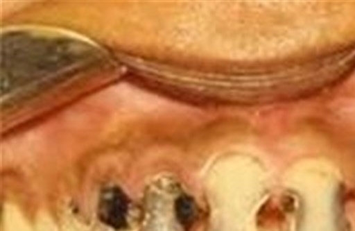نخ دندان برای بزرگسالان موثرتر از مسواک /جرم گیری بیمه شود