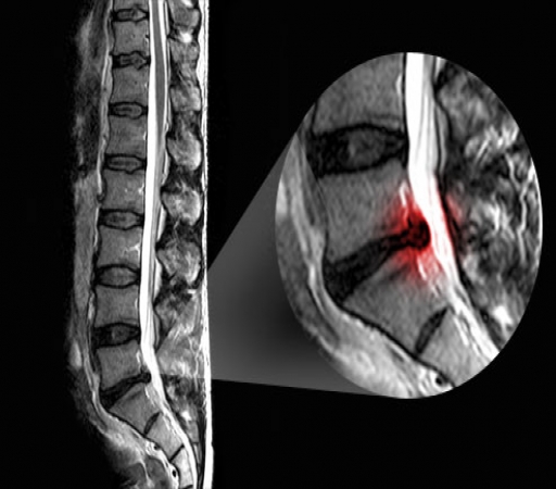 فتق دیسک بین مهره ای