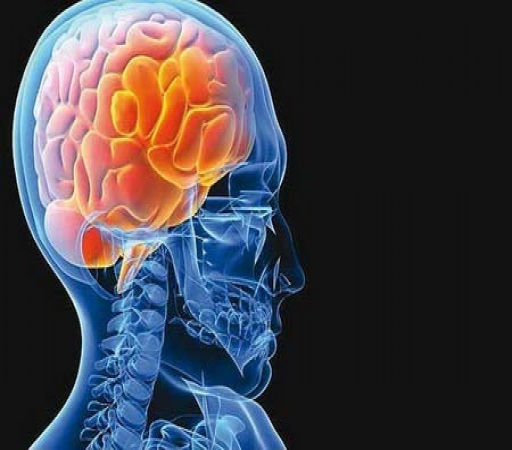 هر ۵ دقیقه یک ایرانی سکته مغزی می کند