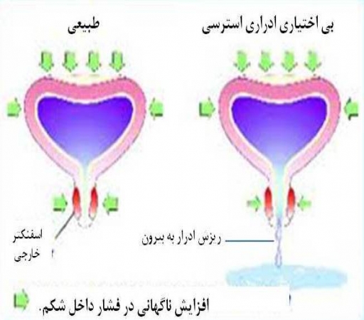 بی اختیاری استرسی