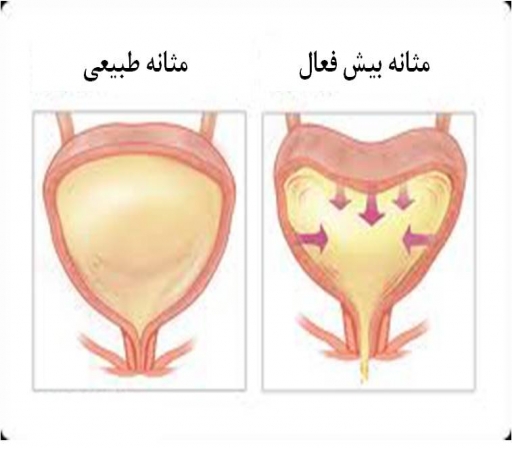 سیستیت یا التهاب مثانه در زنان