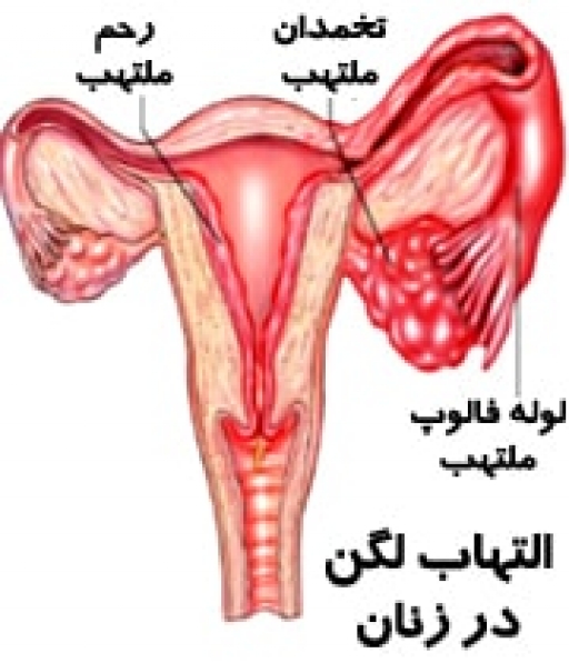 مشکلات بارداری در کمین مبتلایان به التهابات لگنی