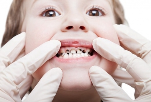 پوسیدگی دندان، دومین بیماری شایع عفونی