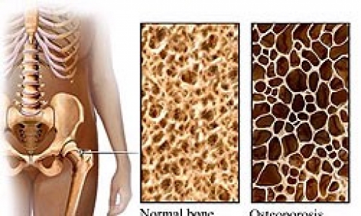 پوکی استخوان شایع‌ترین بیماری دوران سالمندی/ عوامل بروز پوکی استخوان را بشناسید