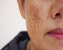 تجمع غیرطبیعی رنگدونه های پوستی
